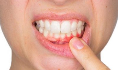 Diş eti iltihabı nasıl geçer?
