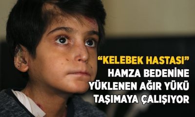 “Kelebek hastası” Hamza bedenine yüklenen ağır yükü taşımaya çalışıyor